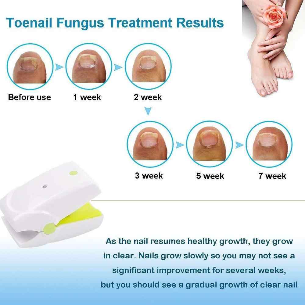Fingernails Toenails Toe Nail Fungus Cold Laser Therapy Onychomycosis Treatment Device