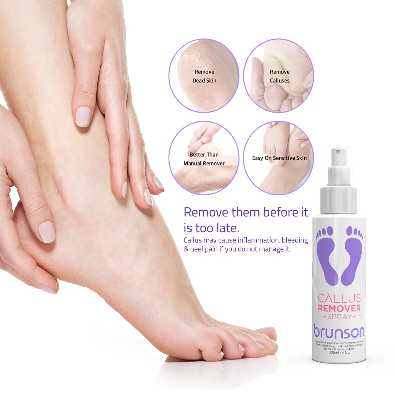 3 Pcs GFOUK Foot Callus Removal Spray, 30ml Foot Heel Callus Remover Spray,  Foot Exfoliating Spray - for Quickly Remove Dead Skin and Calluses on Feet